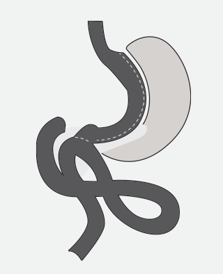 SINGLE ANASTOMOSIS DUODENO-ILEAL BYPASS (SADI)